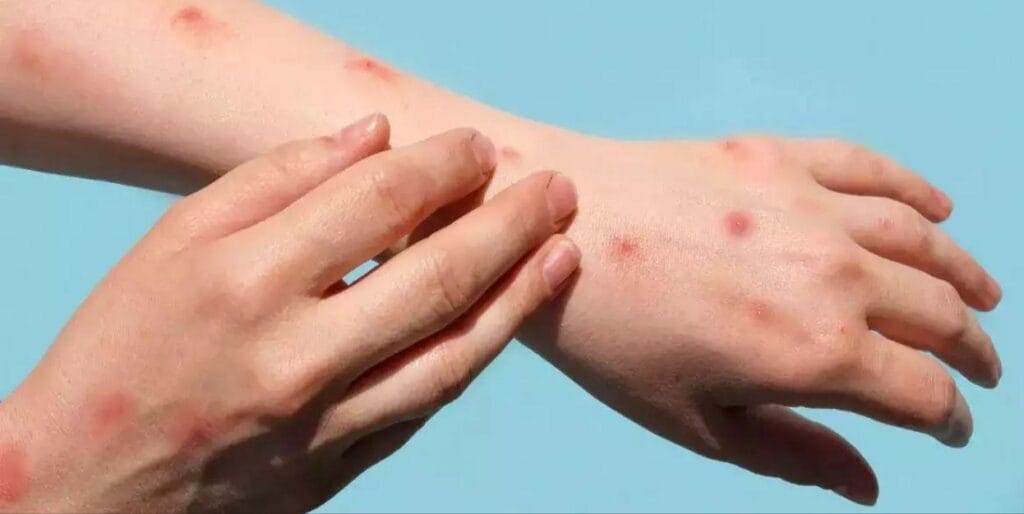 IMG 20240909 201244 New Mpox case reported in India on 09th september: People fear a covid repeat. But nothing to worry so far says Health ministry